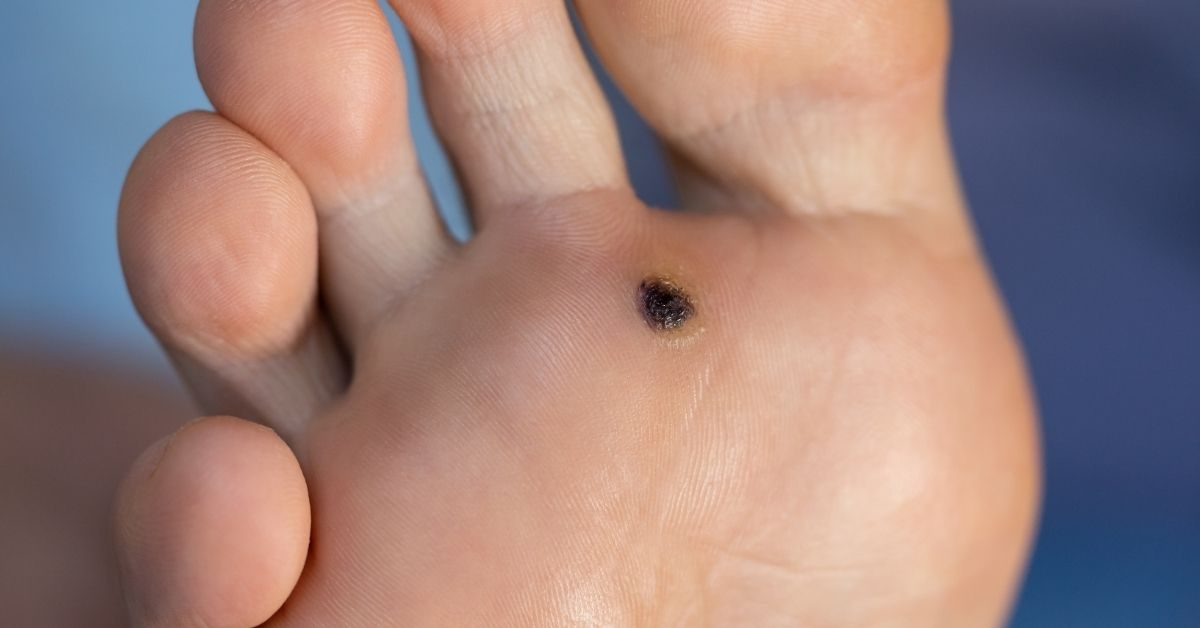 Astrological Meaning of Moles on the Soles of Feet